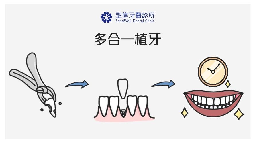 多合一植牙,聖偉牙醫